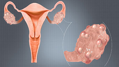 Yumurtalık Kisti Nedenleri Yumurtalık Kistleri belirtisi Yumurtalık Kisti belirtileri Jinekolog OpDr Emrah Kızıldağ Kadın Hastalıkları ve Doğum Doktorları Şişli İstanbul Avrupa Yakası En iyi Kadın Doğum Uzmanı tavsiye ve yorumları